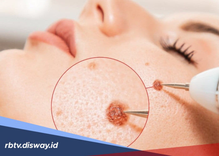 Prosedur Laser Tahi Lalat dan Flek Hitam di Klinik Kecantikan, Serta Estimasi Biaya dan Efek Sampingnya