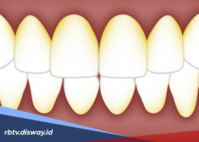 Tak Perlu ke Dokter? Begini 10 Cara Alami Bersihkan Plak Gigi