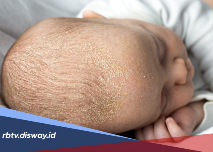 6 Cara Menghilangkan Kerak pada Kepala Bayi dengan Aman