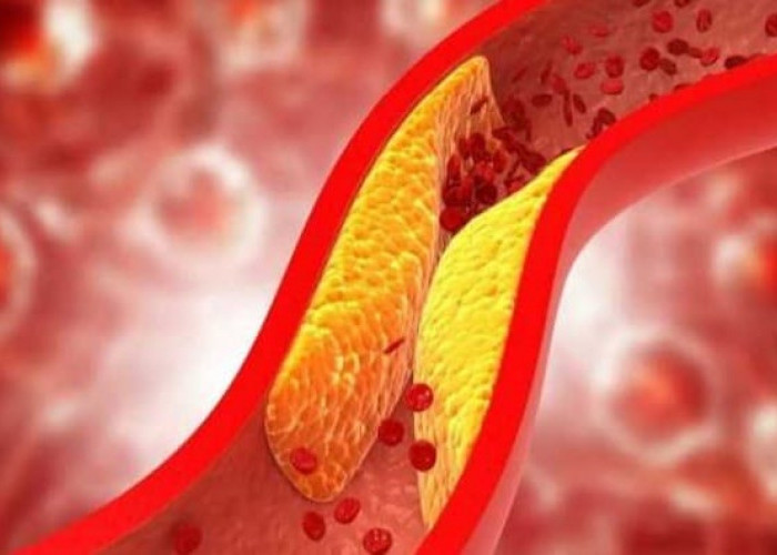 Kolesterol Tinggi Bisa Diatasi dengan Cara Alami, Berikut Cara Menurunkan Kolesterol Tanpa Minum Obat