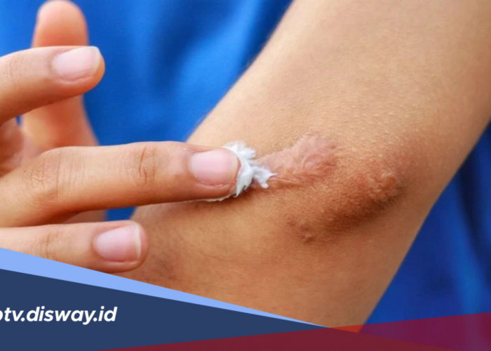 Cara Mengatasi dan Menghilangkan Bekas Luka Agar Kulit Kembali Mulus