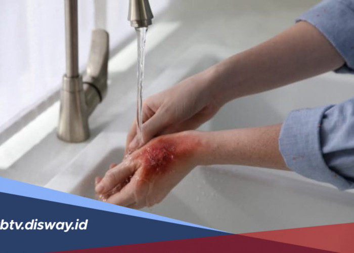 Kulit Terkena Air Panas? Ini Langkah Pertolongan Pertama yang Tepat