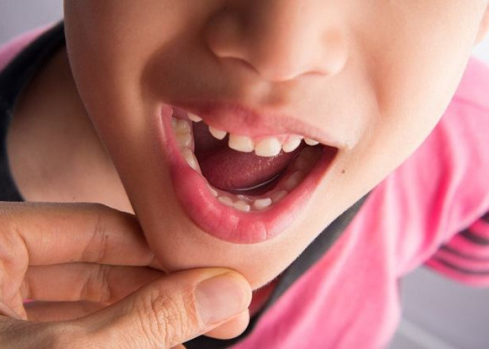 Ini Penyebab Gigi Anak Renggang, Orang Tua Jangan Khawatir! Begini Cara Mengatasinya