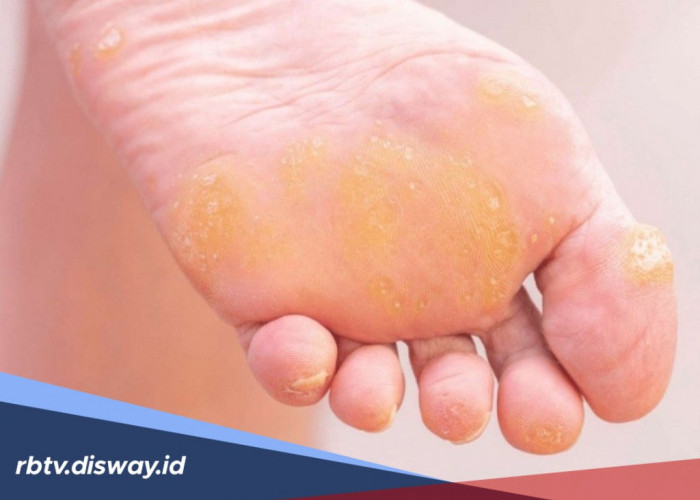 5 Cara Ampuh Hilangkan Kapalan di Kaki dan Tangan Tanpa Perih