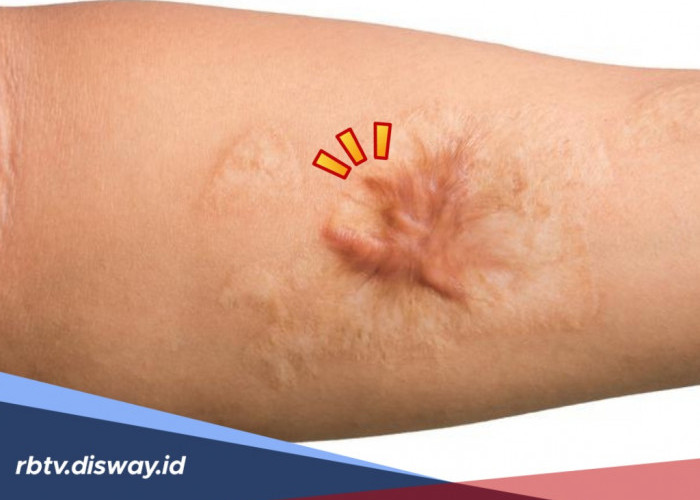 Kembalikan Rasa Percaya Diri, Hempaskan Keloid dengan Cara Alami Berikut