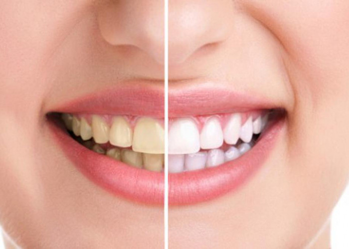 Ternyata 4 Kebiasaan ini Dapat Membuat Gigi Anda Menguning, Simak Juga Cara Mencerahkannya