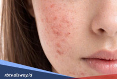 Urutan Pemakaian Skincare Malam yang Tepat untuk Menghilangkan Bekas Jerawat dan Flek