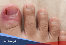 Kaki Terasa Nyut-Nyutan? Ini Cara Mengatasi dan Mencegah Cantengan