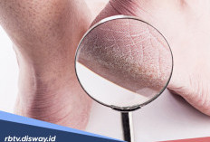 Tanpa Dokter, Ini 10 Cara Mengatasi Kaki Pecah-pecah Secara Permanen