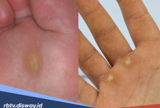 7 Cara Menghilangkan Kapalan di Kaki dan Tangan Secara Permanen
