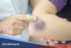 Mengenal Hematoma, Penyebab, Gejala, dan Cara Mengobatinya