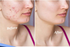 Ini Dia Cara Menghilangkan Bopeng Bekas Cacar, Dijamin Ampuh dan Sembuh