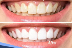 Tak Perlu Mahal, Begini Cara Memutihkan Gigi dengan Bahan Alami 