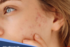 5 Cara Menghilangkan Bekas Jerawat dengan Bahan Alami