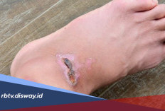 Ini Rahasianya dan Perawatan Menghilangkan Koreng di Kaki