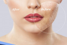 Terbukti Ampuh, Begini Cara Mudah Hempaskan Bopeng Bekas Jerawat 