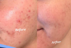 Rahasia Wajah Mulus, Ini Cara Menghilangkan Jerawat dengan Bahan Alami