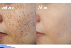 Cara Ampuh Menghilangkan Bopeng di Wajah, Bikin Tampil Lebih Percaya Diri