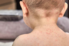 Sering Menyerang Anak-anak, Kenali Penyebab Penyakit Kawasaki dan Cara Pengobatannya