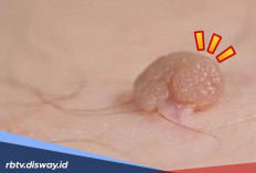 5 Cara Alami Menghilangkan Kutil yang Buat Kamu Kurang Pede
