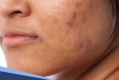 Skincare Terbaik yang Terbukti Ampuh Memudarkan Bekas Jerawat Hitam (PIH) dengan Cepat