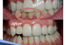 Bukan Sulap, Ini Cara Menghilangkan Karang Gigi Membandel Secara Alami 