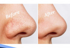 Bukan Dipencet, Begini Cara Menghilangkan Komedo dengan Bahan Alami