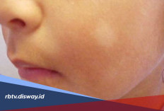Mitos Tanda Lahir Putih: Benarkah Pertanda Keberuntungan?