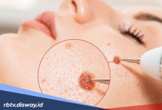 Prosedur Laser Tahi Lalat dan Flek Hitam di Klinik Kecantikan, Serta Estimasi Biaya dan Efek Sampingnya