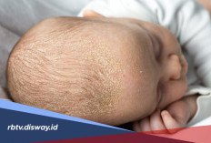 6 Cara Menghilangkan Kerak pada Kepala Bayi dengan Aman