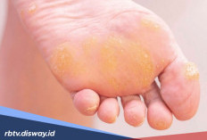 5 Cara Ampuh Hilangkan Kapalan di Kaki dan Tangan Tanpa Perih