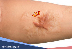 Kembalikan Rasa Percaya Diri, Hempaskan Keloid dengan Cara Alami Berikut